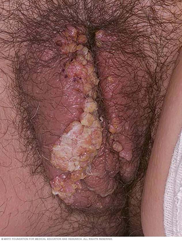ویروس پاپیلومای انسانی (HPV) در زنان