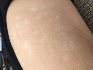 آیا لکه های سفید روی پوست از کمبود ویتامین است؟