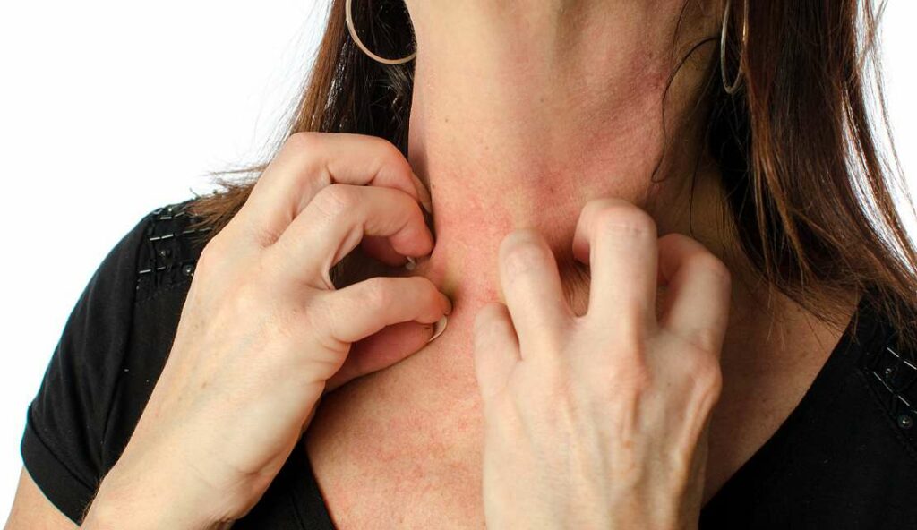 راش های پوستی ناشی از واکنش آلرژیک به یک دارو