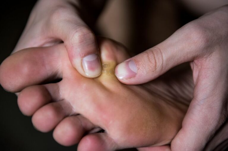 درمان میخچه کف پا دکتر عباس انتظاری متخصص بیماری های جنسی